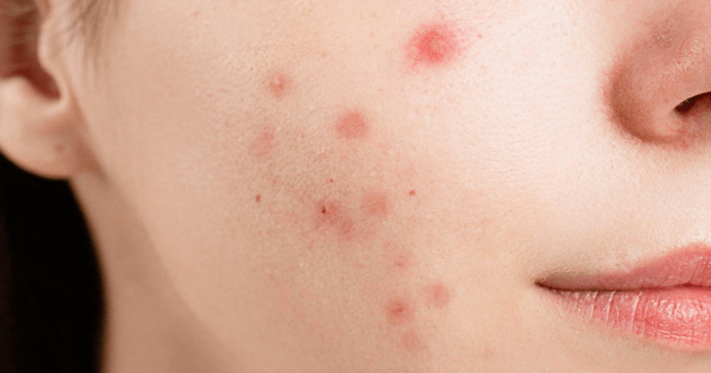 How to get rid of a pimple in 5 minutes?