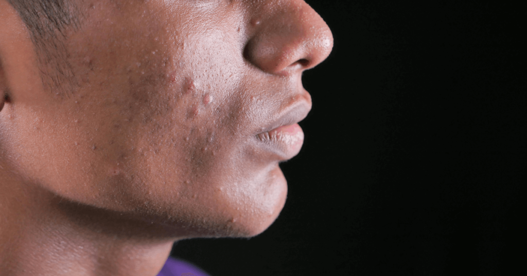 How to get rid of a pimple in 5 minutes?