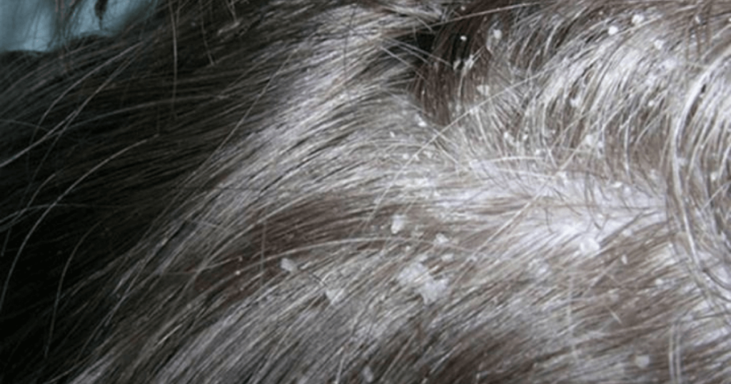 how to get rid of dandruff