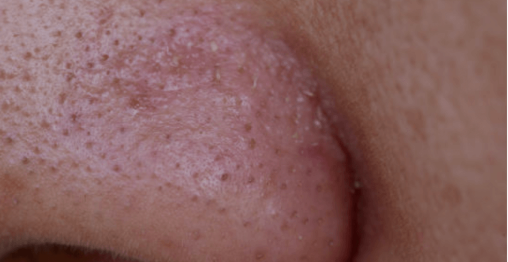 how to get rid of whiteheads overnight.