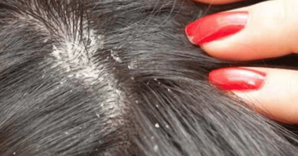 dry scalp vs dandruff